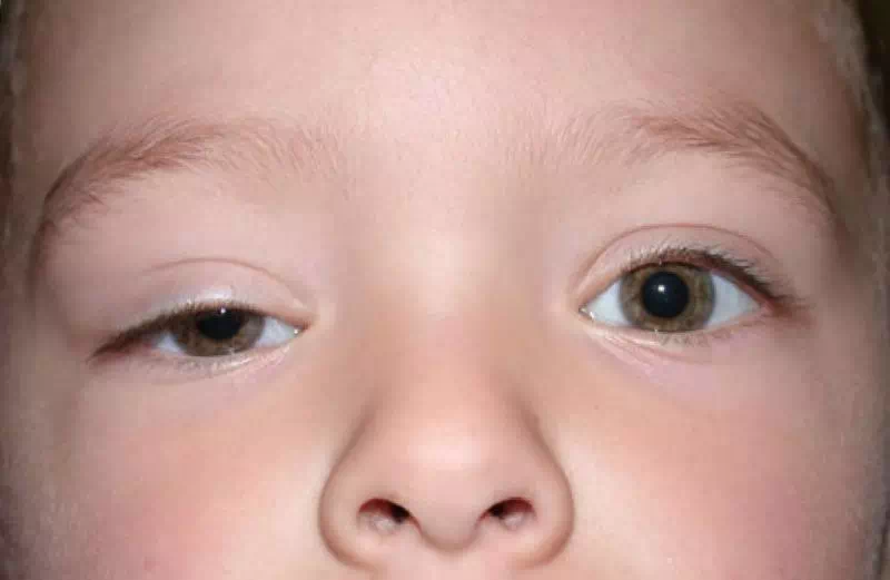 درمان افتادگی پلک نوزادان